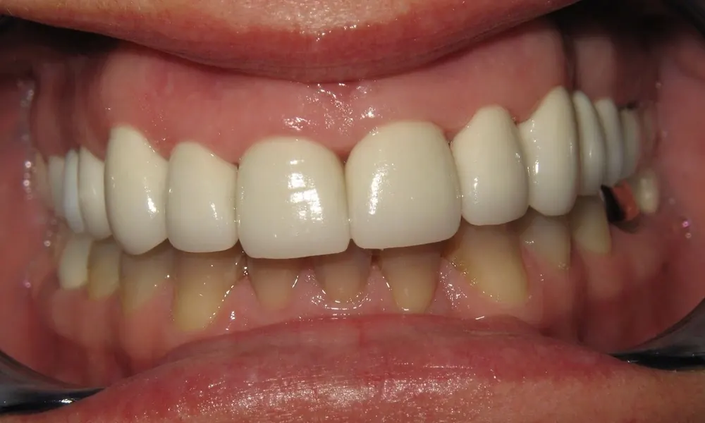 After: the upper front teeth restored with bright porcelain crowns.