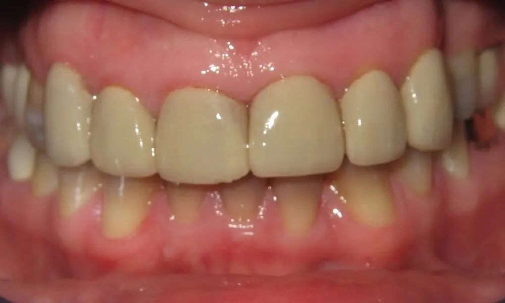 Before: discoloured, worn upper front teeth.