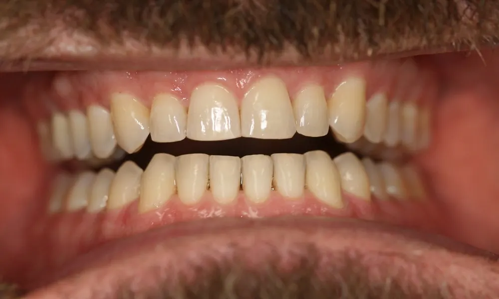 After: the same smile with the gaps closed.