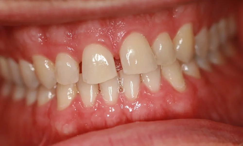 Before: gaps between the upper front teeth.