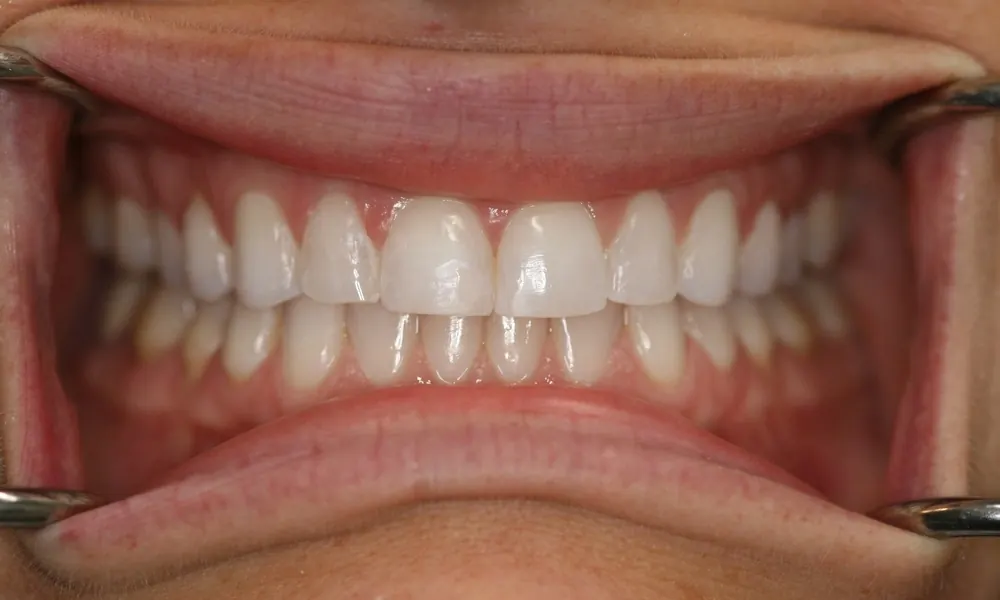 After: the same smile with the teeth evenly aligned.