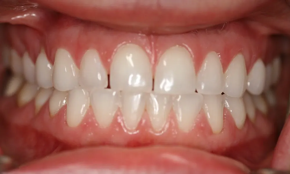 Before: front teeth with a gap and uneven alignment.